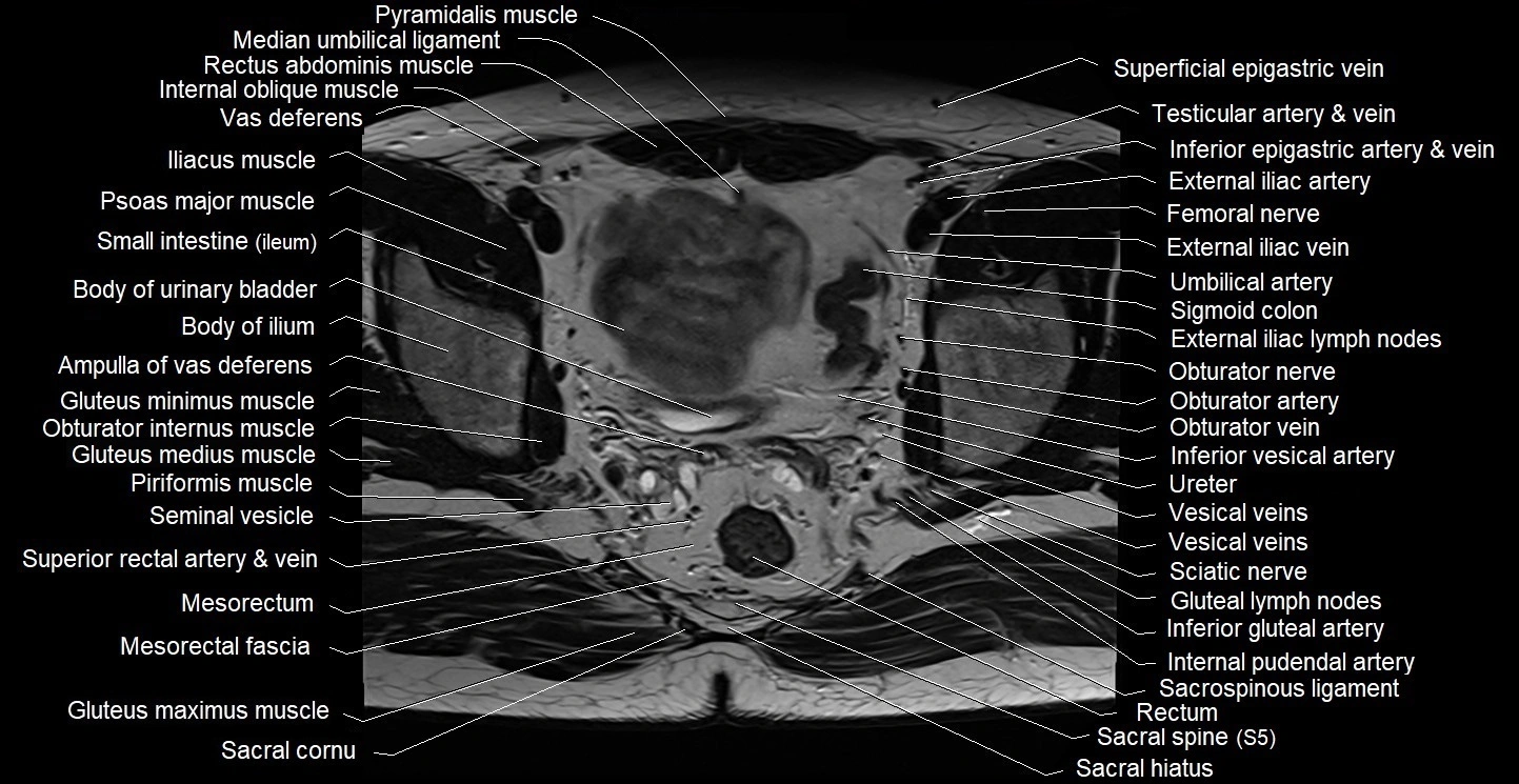 Male pelvis axial cross sectional anatomy image 21.webp